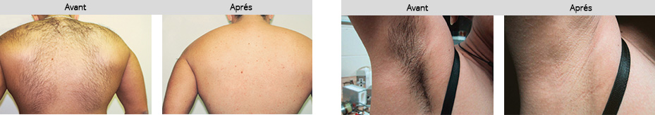 laser epilatoire gentle pro