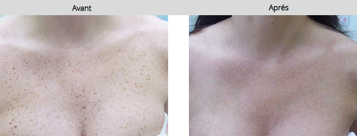 epilation pigmentaire