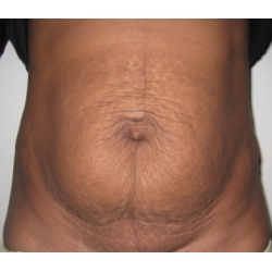 Abdominoplastie : cicatrice en T , diastasis abdominal post grossesse gemellaire.