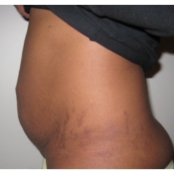 Abdominoplastie : cicatrice en T , diastasis abdominal post grossesse gemellaire.