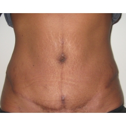 Abdominoplastie : cicatrice en T , diastasis abdominal post grossesse gemellaire.