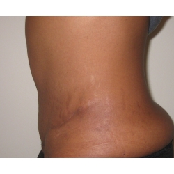 Abdominoplastie : cicatrice en T , diastasis abdominal post grossesse gemellaire.