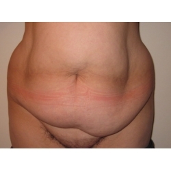 Abdominoplastie : traitement chirurgical d'un tablier abdominal.