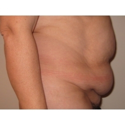 Abdominoplastie : traitement chirurgical d'un tablier abdominal.