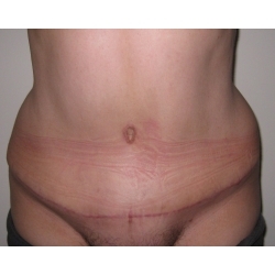 Abdominoplastie : traitement chirurgical d'un tablier abdominal.