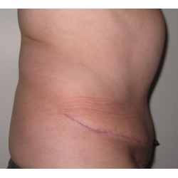 Abdominoplastie : traitement chirurgical d'un tablier abdominal.