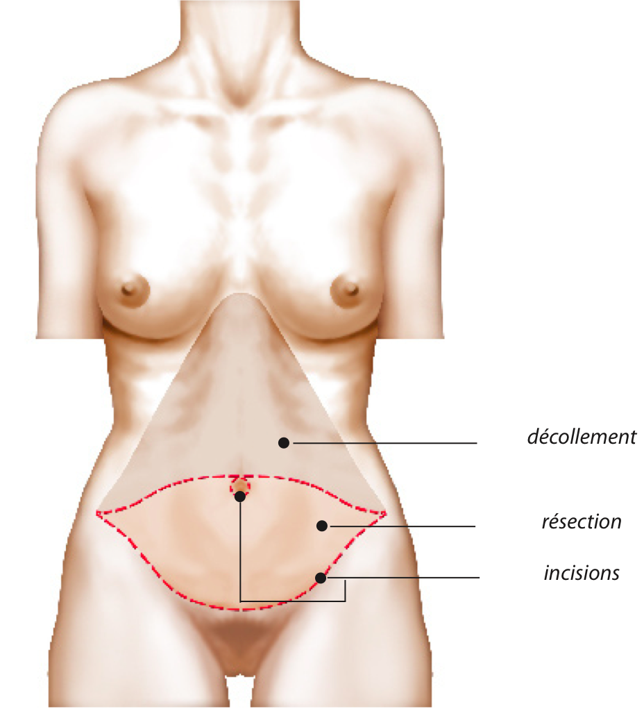 plastie abdominale