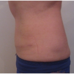 abdominoplastie avec transposition de l'ombilic et lipoaspiration , résultat à six mois