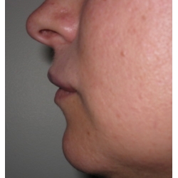 Volume et avancée d'une lèvre supérieure en retrait par acide hyaluronique.