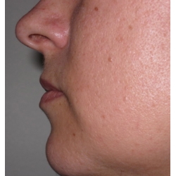 Volume et avancée d'une lèvre supérieure en retrait par acide hyaluronique.