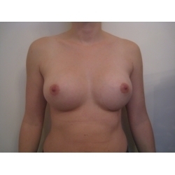 augmentation mammaire par prothèses anatomiques sous musculaires , 370 cc, voie sous mammaire