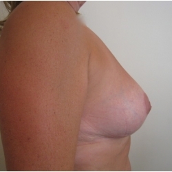 Réduction mammaire bilatérale