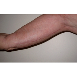Lifting de bras , aspect cicatriciel à 3 mois