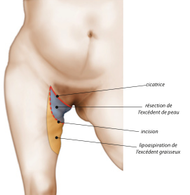 Lifting des cuisses