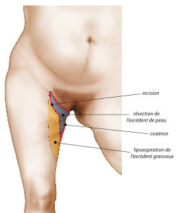 Lifting des cuisses