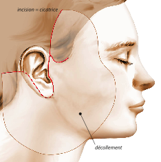 lifting visage cervico-facial