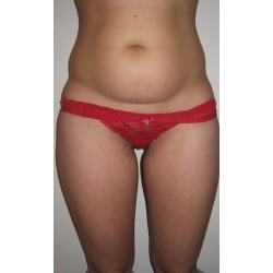 Liposuccion abdominale.