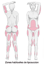 Liposuccion du ventre
