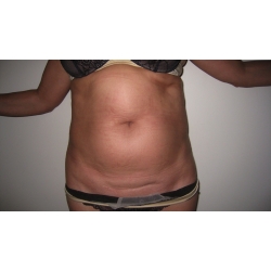 Lipoaspiration abdominale et poignets d’amour, patiente de 63 ans