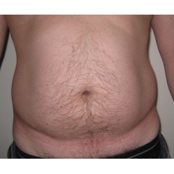 liposuccion abdominale de l'homme