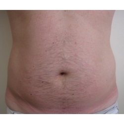 liposuccion abdominale de l'homme