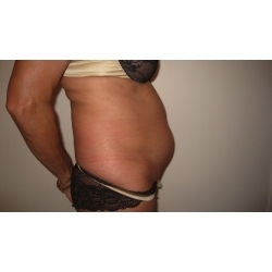 Lipoaspiration abdominale et poignets d’amour, patiente de 63 ans