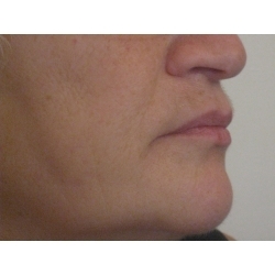 lipostructure du bas du visage (lèves sup et inf, joues, menton)