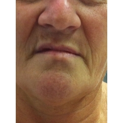 lipostructure du bas du visage (lèves sup et inf, joues, menton)