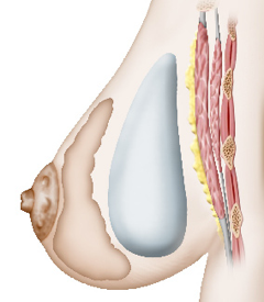 Augmentation mammaire