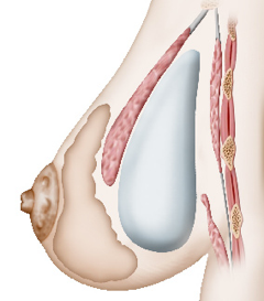 Augmentation mammaire