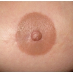 Reconstruction areole par greffe d'hémi-mamelon + dermopigmentation ou tatouage.