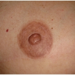 Reconstruction areole par greffe d'hémi-mamelon + dermopigmentation ou tatouage.