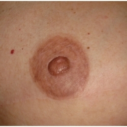 Reconstruction areole par greffe d'hémi-mamelon + dermopigmentation ou tatouage.