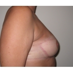 Reconstruction mammaire par lambeau de grand dorsal avec prothèse