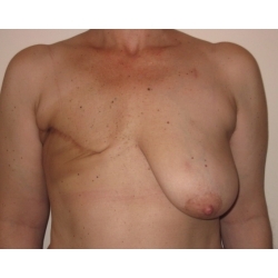 Reconstruction mammaire / grand dorsal + symetrisation par réduction