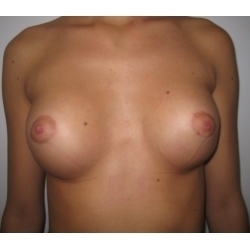 augmentation mammaire, avec correction de la forme tubéreuse, prothèses anatomiques, voie périaréolaire circulaire